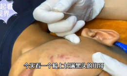 去黑头视频,告别毛孔烦恼——跟随视频教程学技巧